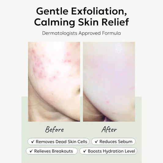 Celimax Jiwoogae Heartleaf BHA Peeling Pad exfoliating pore care blackheads clear skin Cyprus