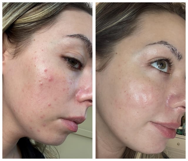 Anua Azelaic Acid 10 Hyaluron Redness Soothing Serum calming redness uneven skin tone Cyprus
