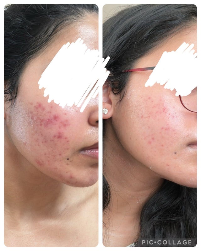Anua Azelaic Acid 10 Hyaluron Redness Soothing Serum calming redness uneven skin tone Cyprus