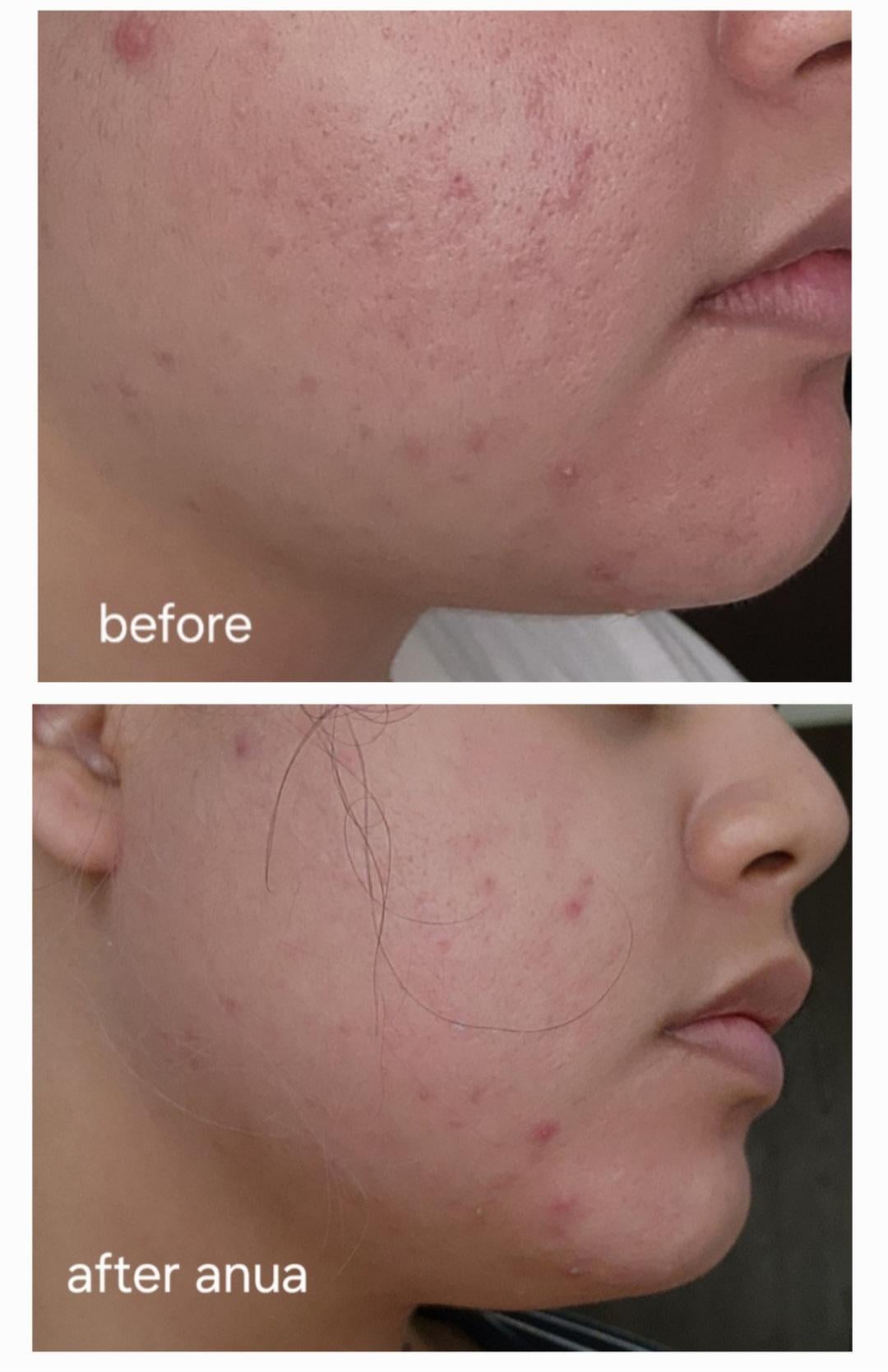 Anua Azelaic Acid 10 Hyaluron Redness Soothing Serum calming redness uneven skin tone Cyprus